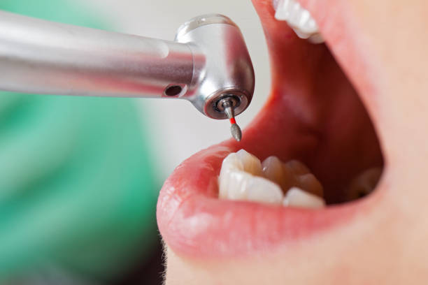 Best Emergency Tooth Extraction in Skiato, OK